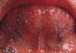 舌裏側の静脈が鬱血
